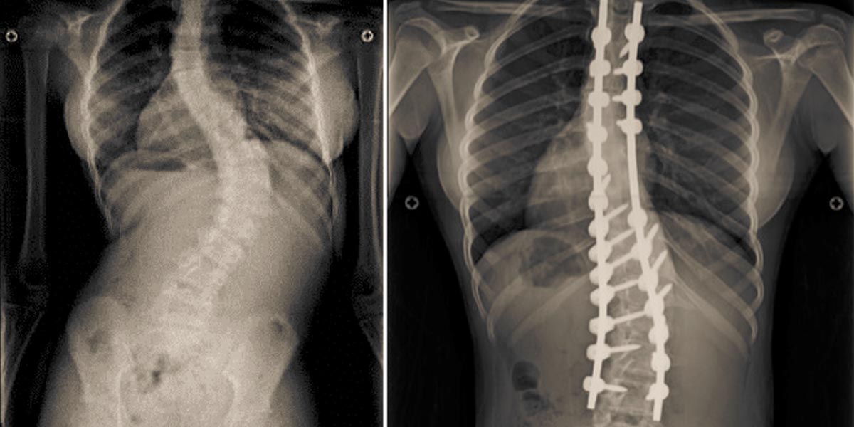 Scoliosis surgery